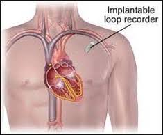 Implantable Loop Recorder (ILR)